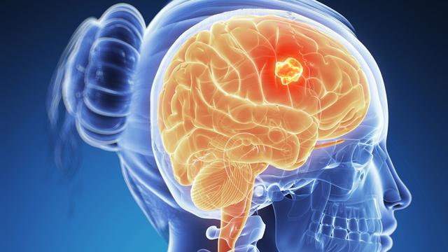 Faktor Penyebab, Gejala dan Pengobatan untuk Kanker Otak